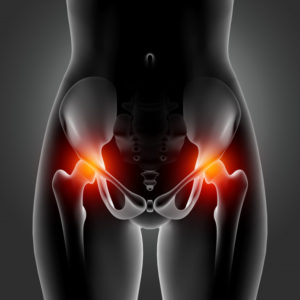 l'artrosi dell'anca